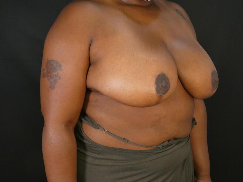 Breast Reduction Before & After Image