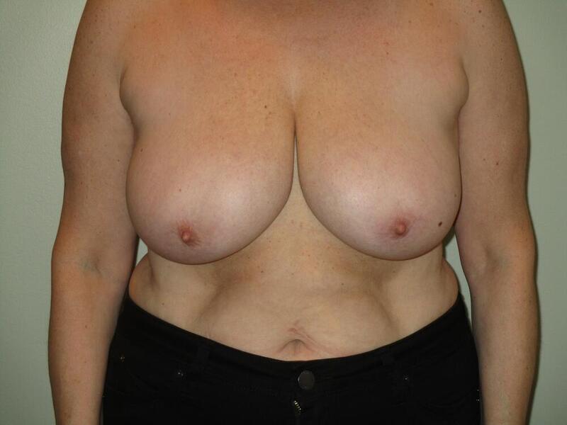 Breast Reduction Before & After Image