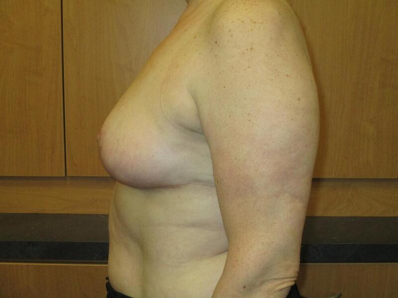 Breast Reduction Before & After Image