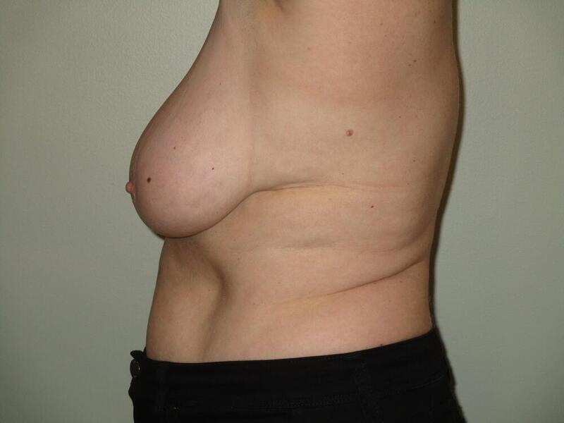 Breast Reduction Before & After Image