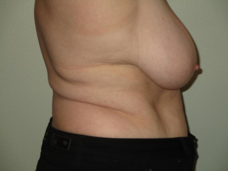 Breast Reduction Before & After Image