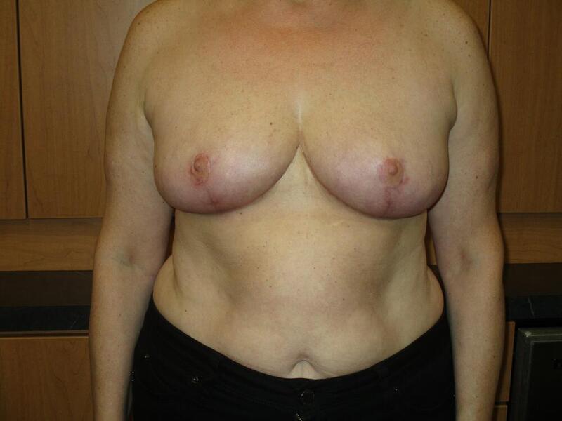 Breast Reduction Before & After Image