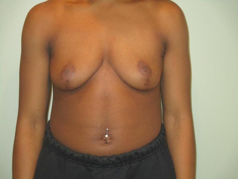 Breast Reduction Before & After Image