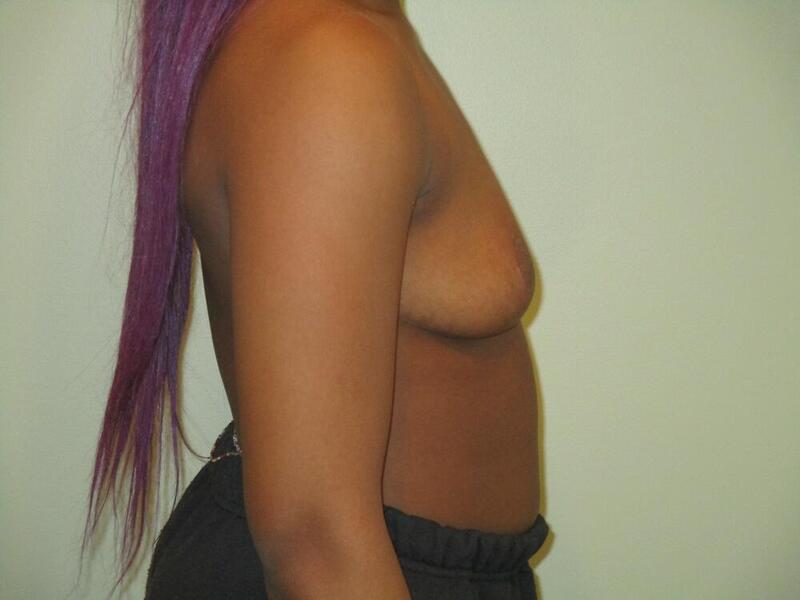 Breast Reduction Before & After Image