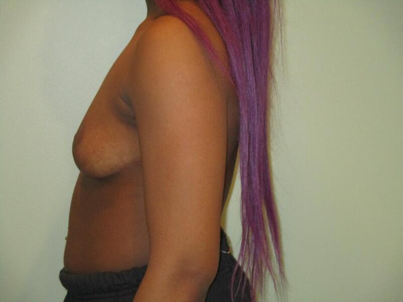 Breast Reduction Before & After Image