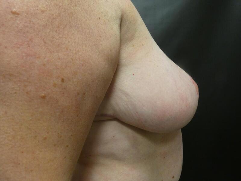 Breast Reduction Before & After Image