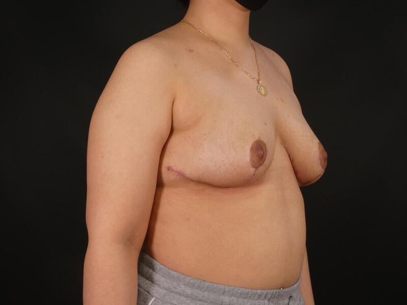 Breast Reduction Before & After Image