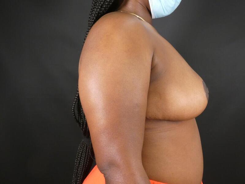 Breast Reduction Before & After Image