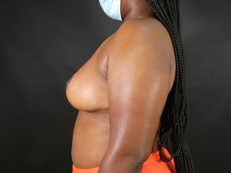 Breast Reduction Before & After Image