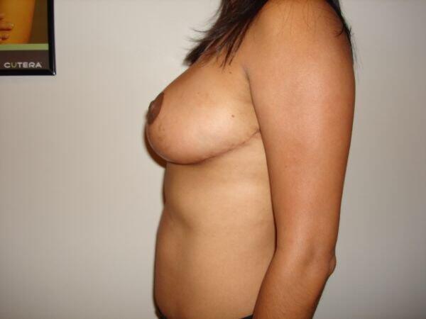 Breast Reduction Before & After Image