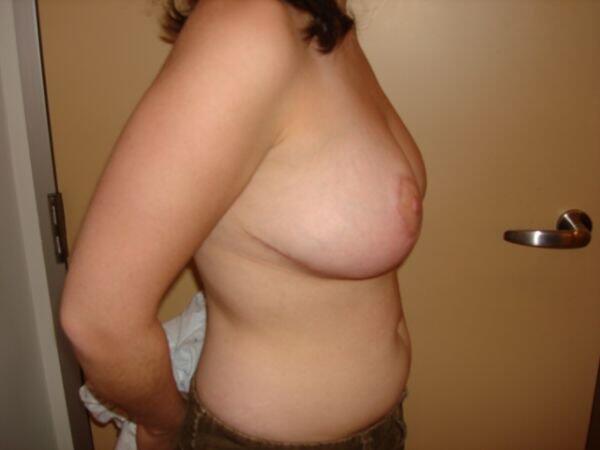 Breast Reduction Before & After Image