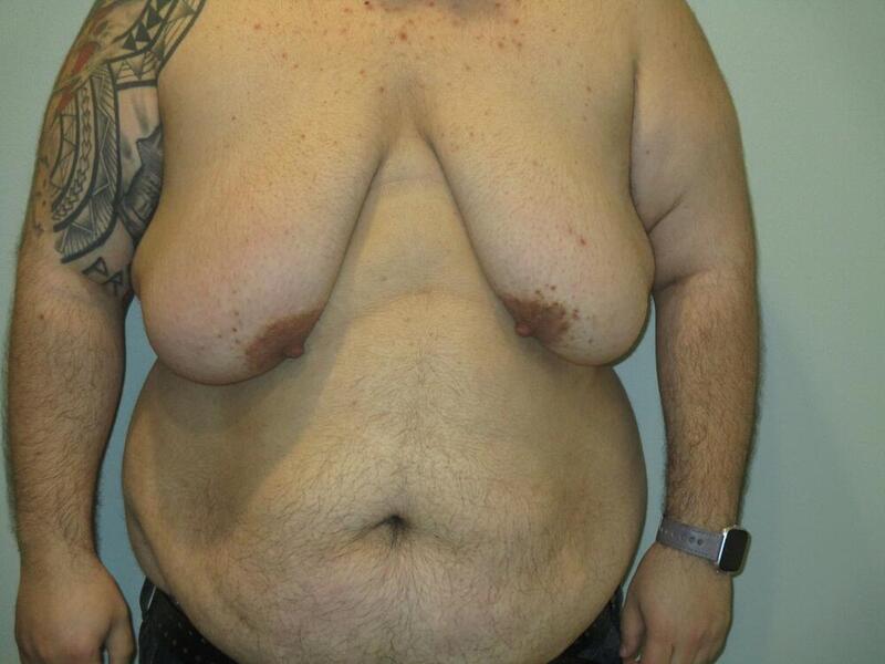 Gynecomastia Correction Before & After Image