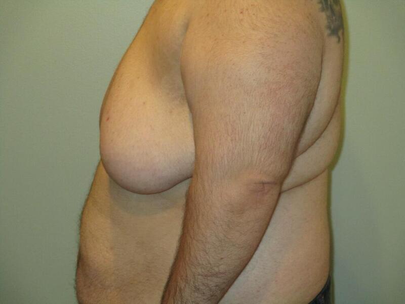 Gynecomastia Correction Before & After Image