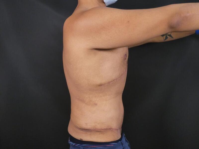 Gynecomastia Correction Before & After Image