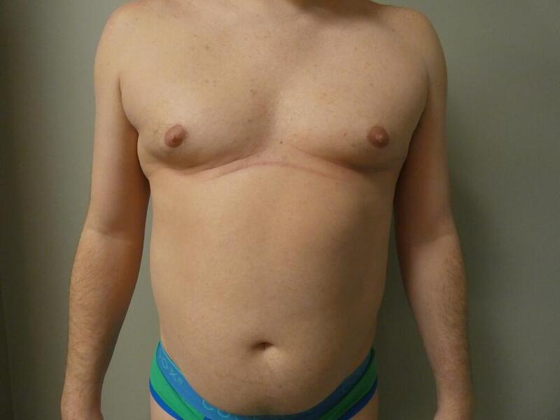 Gynecomastia Correction Before & After Image