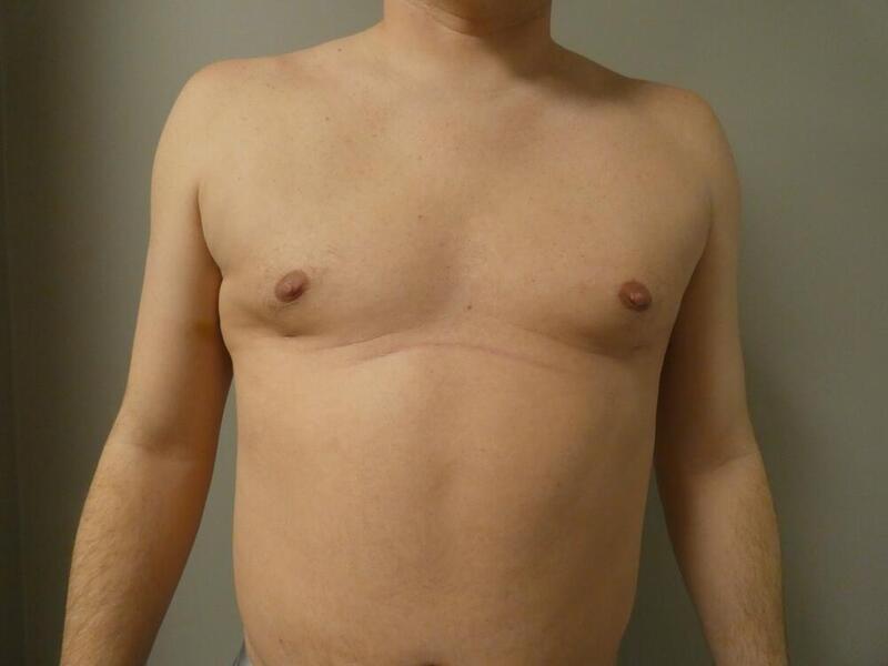 Gynecomastia Correction Before & After Image