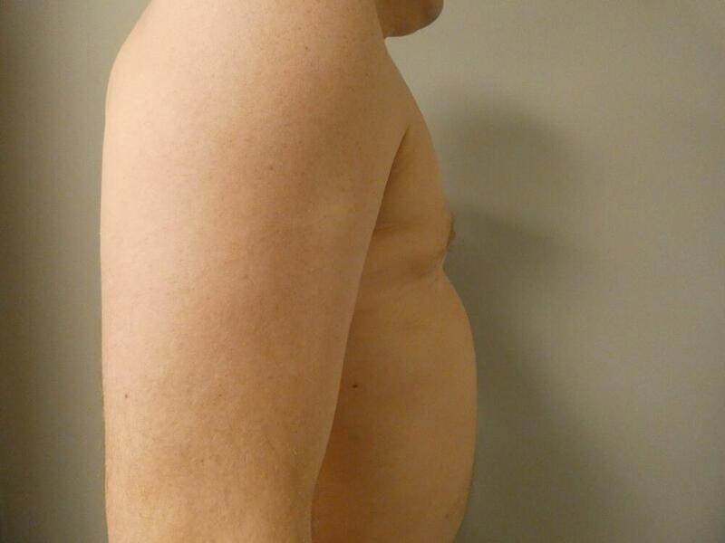 Gynecomastia Correction Before & After Image