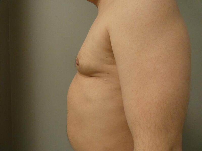 Gynecomastia Correction Before & After Image