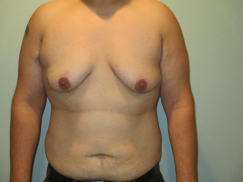 Gynecomastia Correction Before & After Image