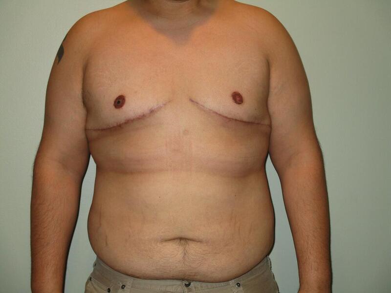 Gynecomastia Correction Before & After Image