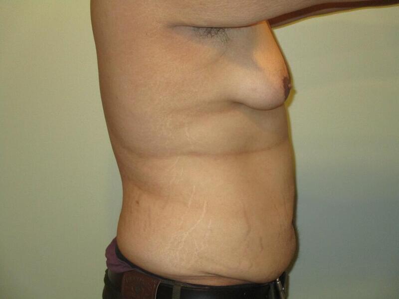 Gynecomastia Correction Before & After Image