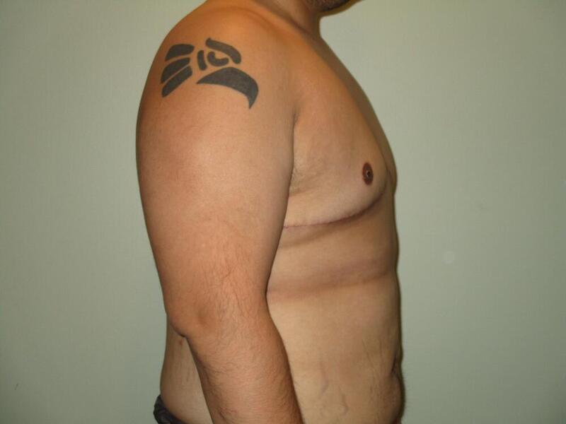 Gynecomastia Correction Before & After Image