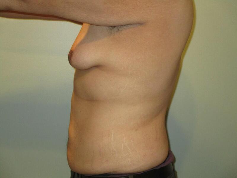 Gynecomastia Correction Before & After Image