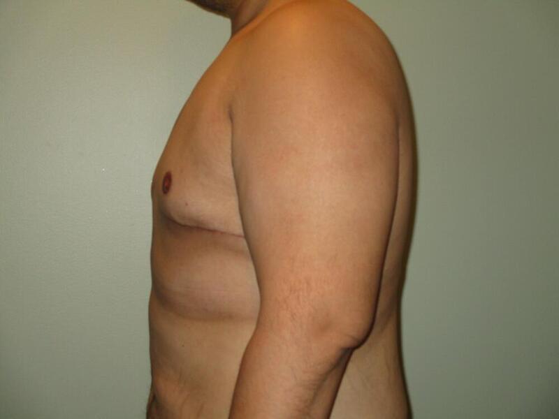 Gynecomastia Correction Before & After Image