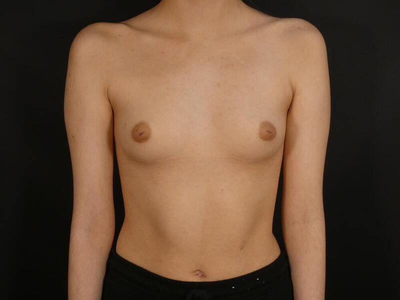 Inverted Nipple Correction Before & After Image