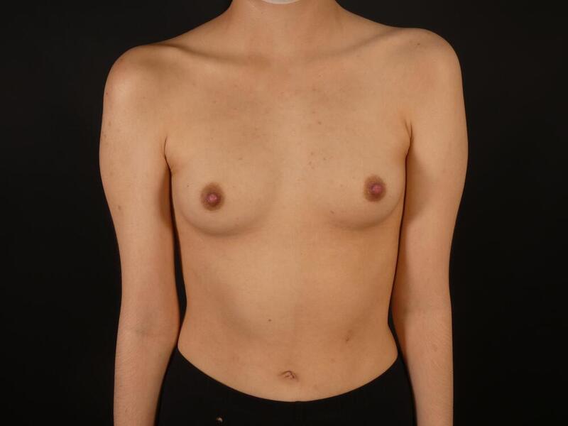 Inverted Nipple Correction Before & After Image