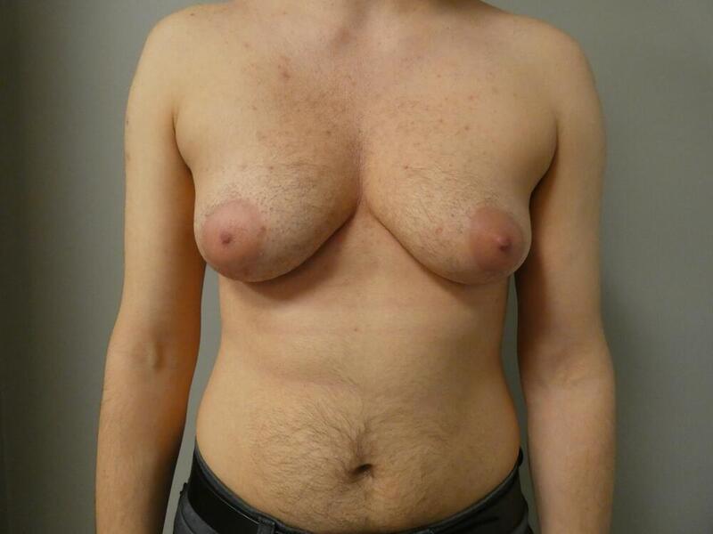 Transmasculine Top Surgery Before & After Image