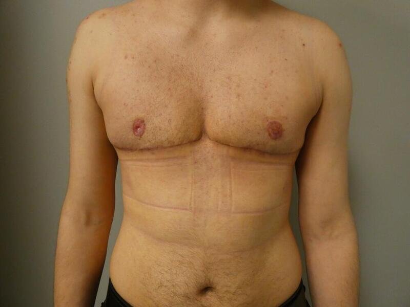 Transmasculine Top Surgery Before & After Image