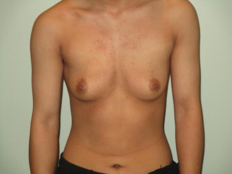 Transmasculine Top Surgery Before & After Image