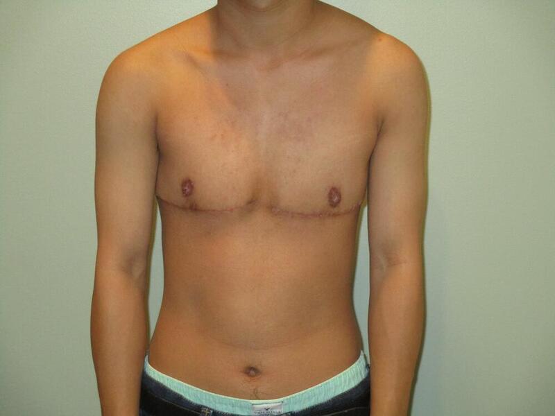 Transmasculine Top Surgery Before & After Image