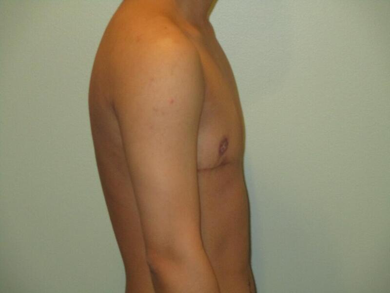 Transmasculine Top Surgery Before & After Image