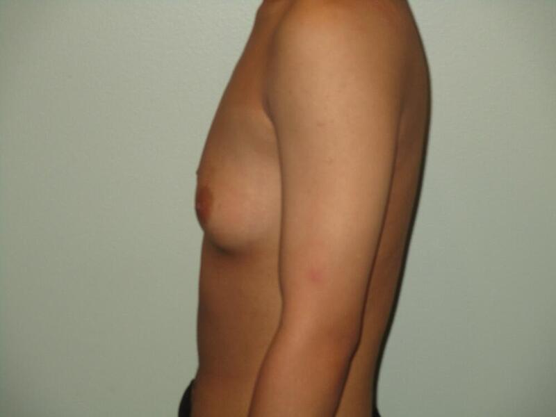 Transmasculine Top Surgery Before & After Image