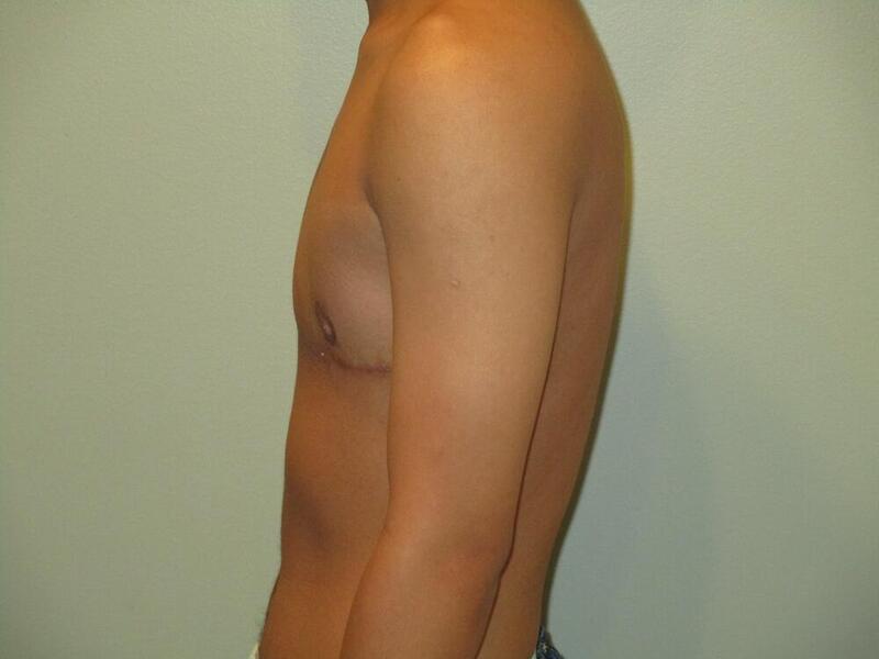 Transmasculine Top Surgery Before & After Image