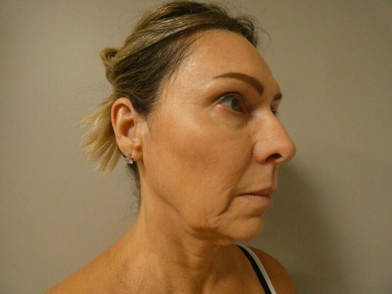 Eyelid Lift  Before & After Image