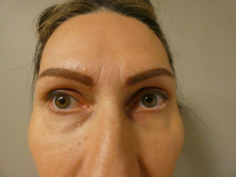 Eyelid Lift  Before & After Image