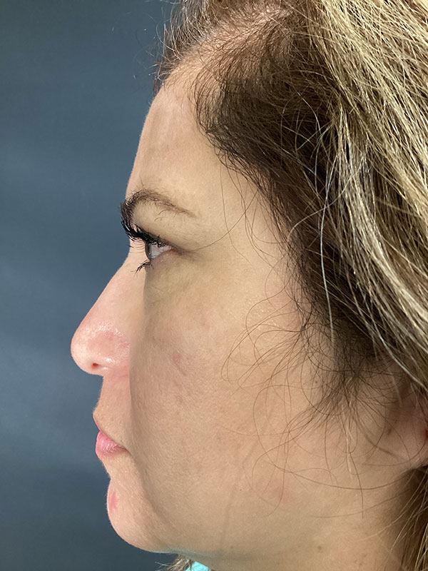 Eyelid Lift  Before & After Image