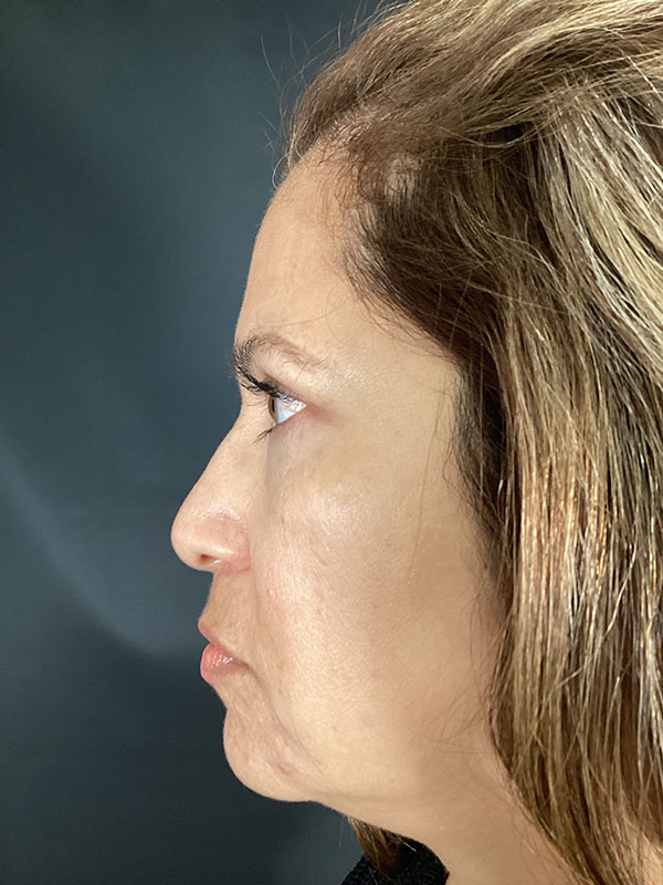 Eyelid Lift  Before & After Image