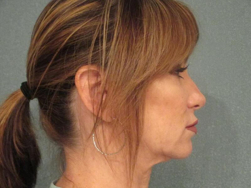 Facelift  Before & After Image