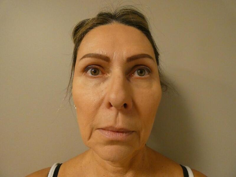 Facelift  Before & After Image