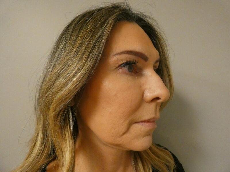 Facelift  Before & After Image