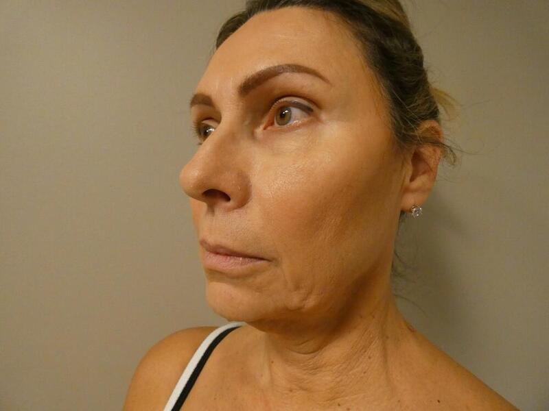 Facelift  Before & After Image