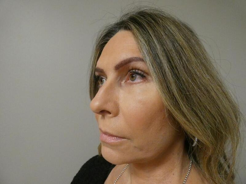 Facelift  Before & After Image