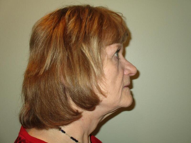 Facelift  Before & After Image