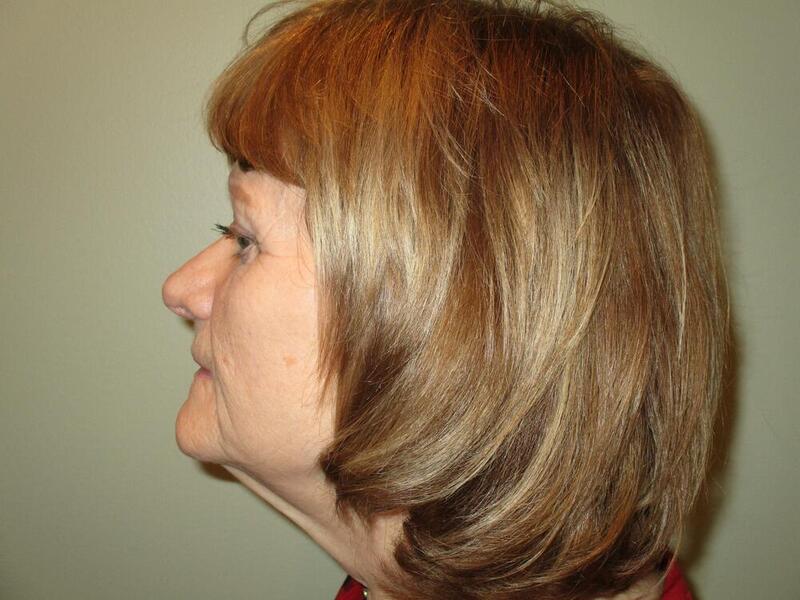 Facelift  Before & After Image