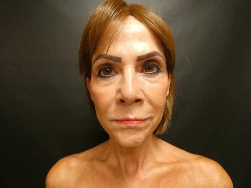 Facelift  Before & After Image