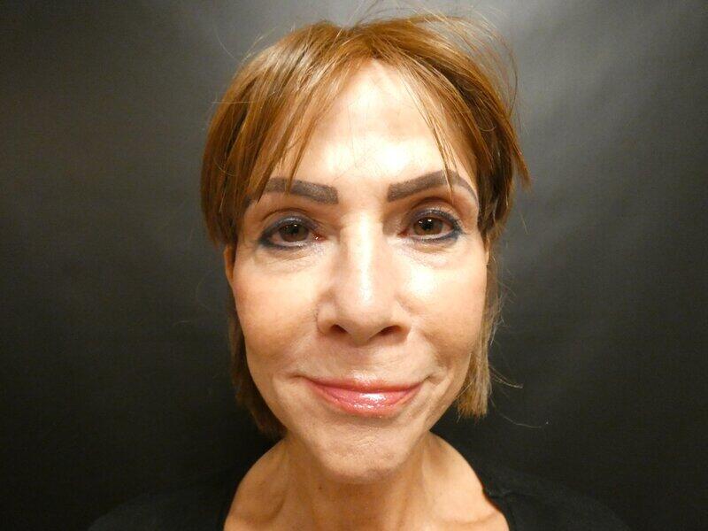 Facelift  Before & After Image